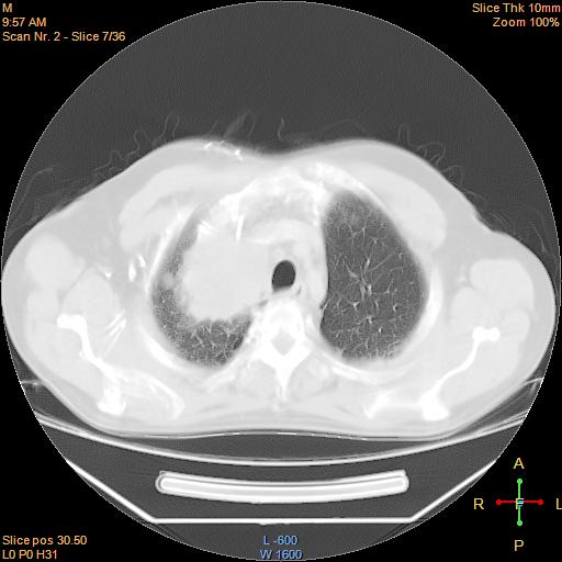 File:Bronchogenic carcinoma with superior vena caval invasion (Radiopaedia 22378-22406 C 4).jpg