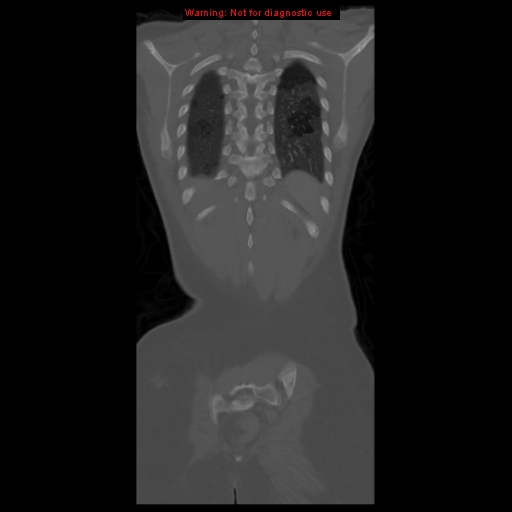 File:Brown tumor (Radiopaedia 12318-12596 D 56).jpg