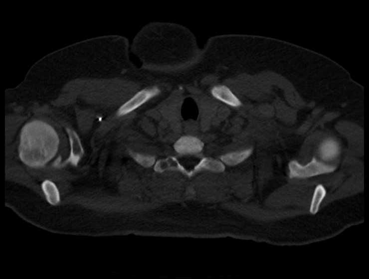 Brown tumors compressing the spinal cord (Radiopaedia 68442-77988 Axial bone window 4).jpg