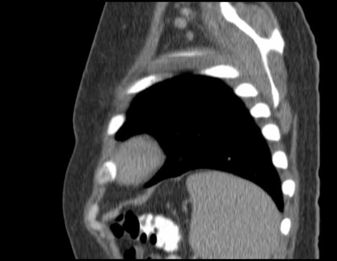 Brown tumors compressing the spinal cord (Radiopaedia 68442-77988 B 49).jpg