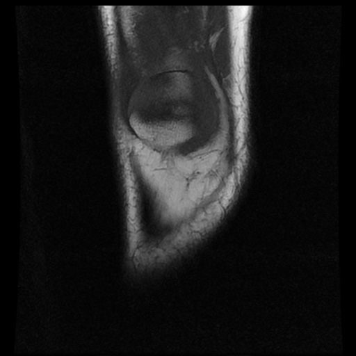 File:Bucket handle meniscus tear (Radiopaedia 56916-63751 Coronal T1 3).jpg