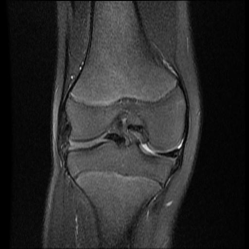File:Bucket handle tear - lateral meniscus (Radiopaedia 72124-82634 Coronal PD fat sat 10).jpg