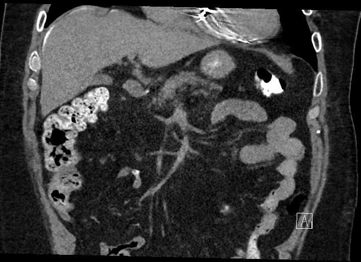 Buried bumper syndrome - gastrostomy tube (Radiopaedia 63843-72577 Coronal Inject 53).jpg