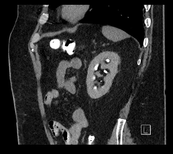 Buried bumper syndrome - gastrostomy tube (Radiopaedia 63843-72577 Sagittal Inject 28).jpg