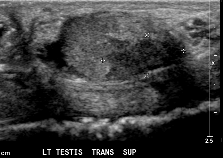 File:Burned-out testicular seminoma - retroperitoneal nodal metastases (Radiopaedia 62872-71731 A 1).png