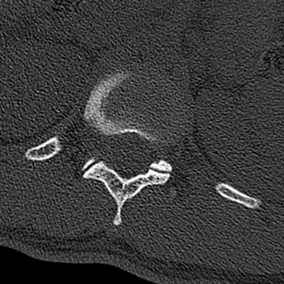 Burst fracture (Radiopaedia 53373-59357 Axial bone window 5).jpg