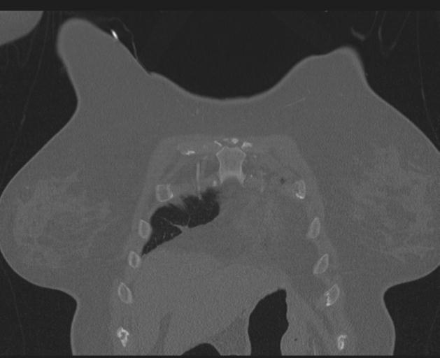 Burst fracture - thoracic spine (Radiopaedia 30238-30865 Coronal bone window 29).jpg