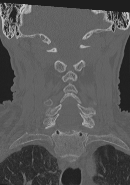 C2 fracture with vertebral artery dissection (Radiopaedia 37378-39199 Coronal bone window 28).png