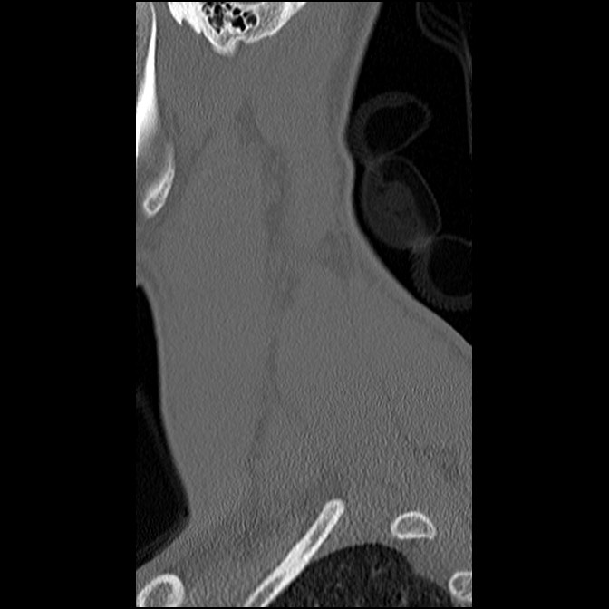 C5 facet fracture (Radiopaedia 58374-65499 Sagittal bone window 63).jpg