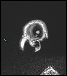 CNS manifestations of NF1 - optic pathway glioma, neurofibroma, dural ectasia (Radiopaedia 37874-39805 Sagittal FLAIR 139).jpg