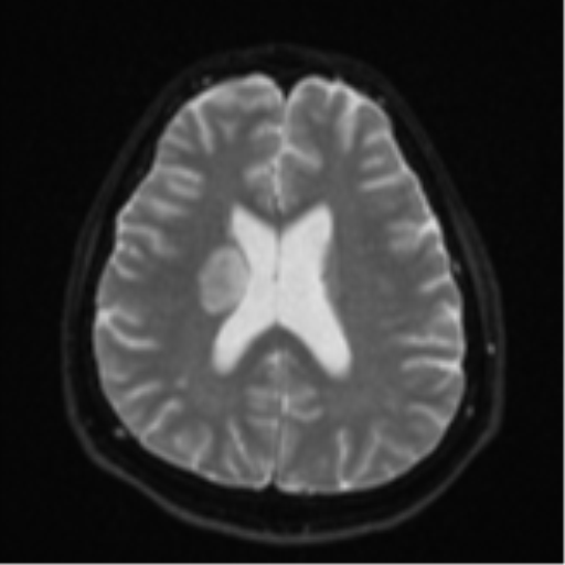 File:CNS vasculitis (Radiopaedia 55715-62263 Axial DWI 19).png