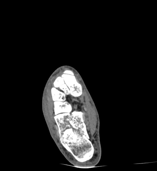 Calcaneal fracture - Sanders type 3ac (Radiopaedia 82491-96862 C 88).jpg
