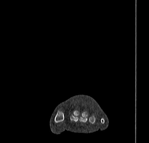 Calcaneal fracture - Sanders type 4 (Radiopaedia 90179-107370 Coronal bone window 19).jpg