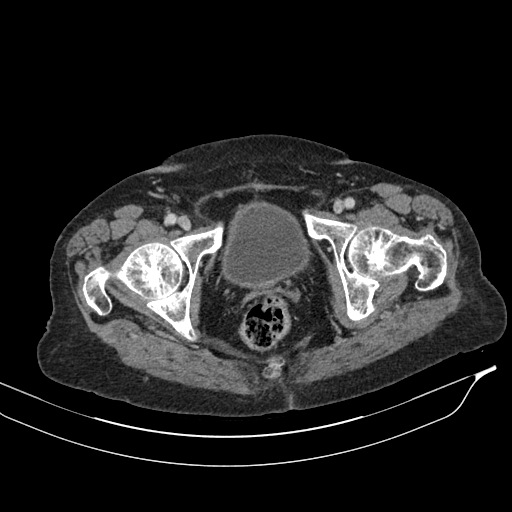 Calcified adrenal glands and Spigelian hernia (Radiopaedia 49741-54988 A 236).jpg