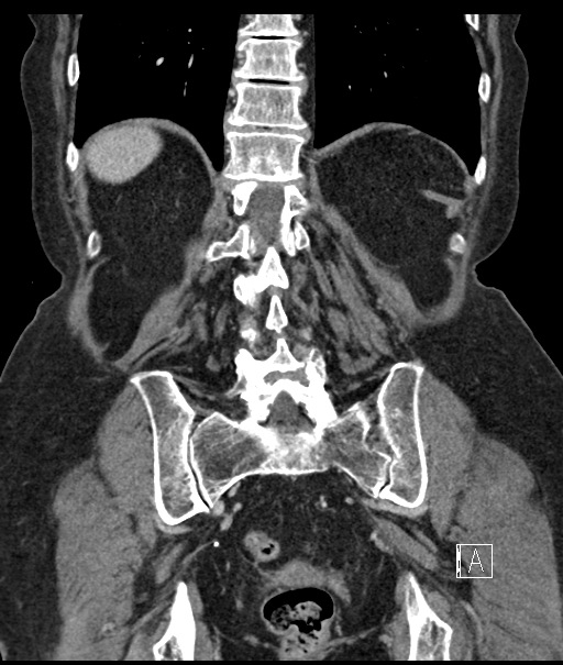 Calcified adrenal glands and Spigelian hernia (Radiopaedia 49741-54988 B 89).jpg
