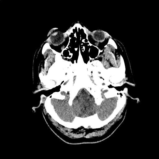 Calcified cerebral hydatid cyst (Radiopaedia 65603-74717 Axial non-contrast 4).jpg