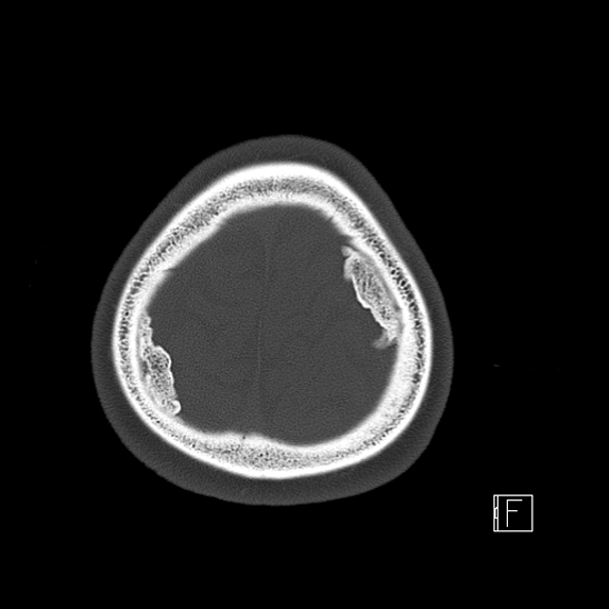 Calcified chronic subdural hematoma (Radiopaedia 77374-89492 Axial bone window 125).jpg