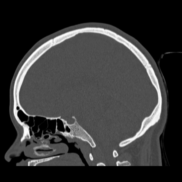 Calvarial osteoma (Radiopaedia 36520-38079 Sagittal bone window 51).jpg