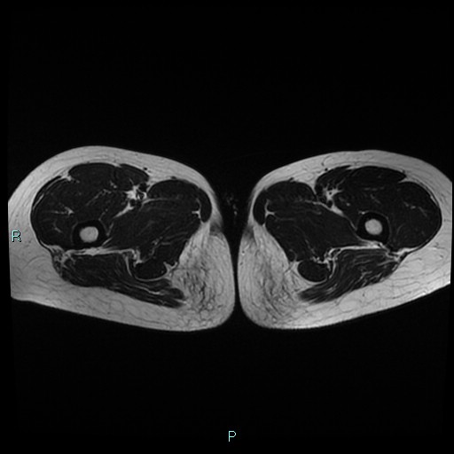 File:Canal of Nuck cyst (Radiopaedia 55074-61448 Axial T2 29).jpg