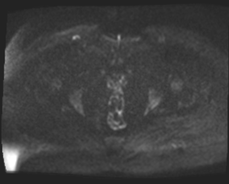 Cancer cervix - stage IIb (Radiopaedia 75411-86615 Axial DWI 62).jpg