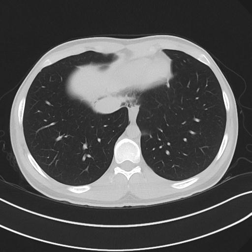File:Cannabis ('bong') smoking induced pneumomediastinum and subcutaneous emphysema (Radiopaedia 29947-30479 C 61).jpg