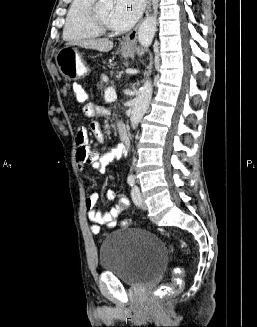 Caput medusae sign - portal hypertension (Radiopaedia 64007-72759 B 45).jpg
