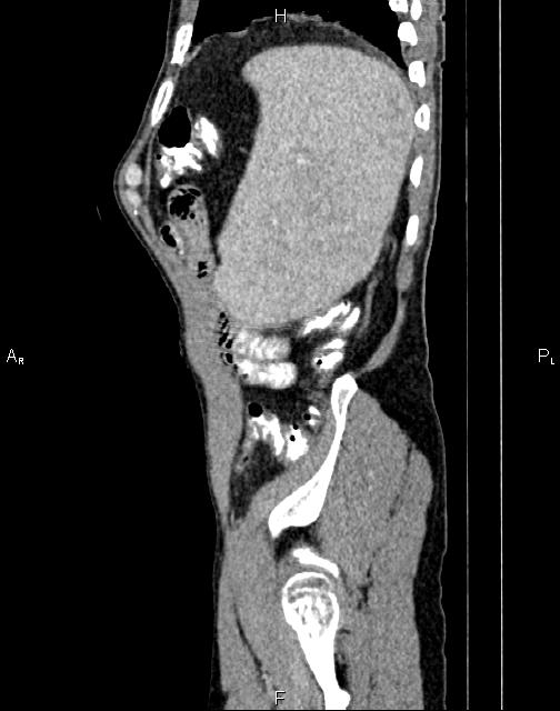 Caput medusae sign - portal hypertension (Radiopaedia 64007-72759 B 76).jpg