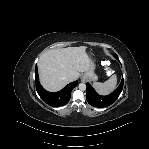 Carcinoid tumor - terminal ileum (Radiopaedia 60931-68739 A 21).jpg
