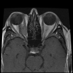 File:Carcinoid tumor of the ileum with metastasis to orbit (Radiopaedia 28165-28424 Axial T1 12).jpg