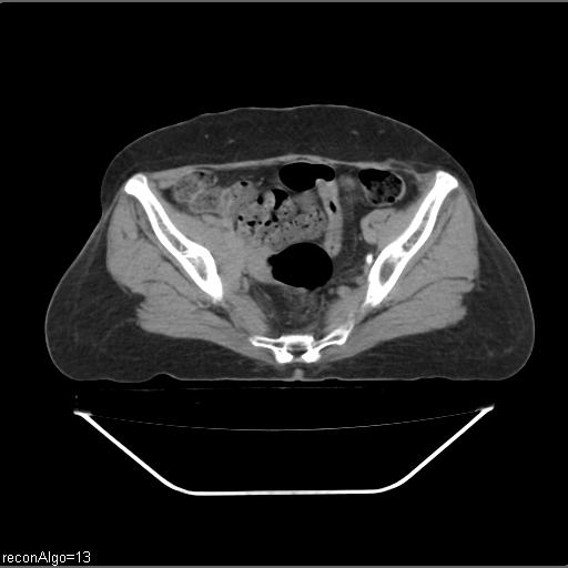 File:Carcinoma cervix- recurrence (Radiopaedia 34702-36137 B 81).jpg