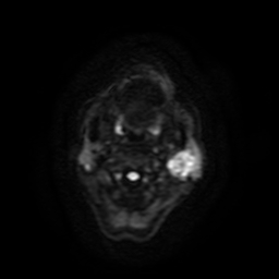 File:Carcinoma ex-pleomorphic adenoma of parotid (Radiopaedia 28383-28627 Ax DWI B-500 GE 52).jpg