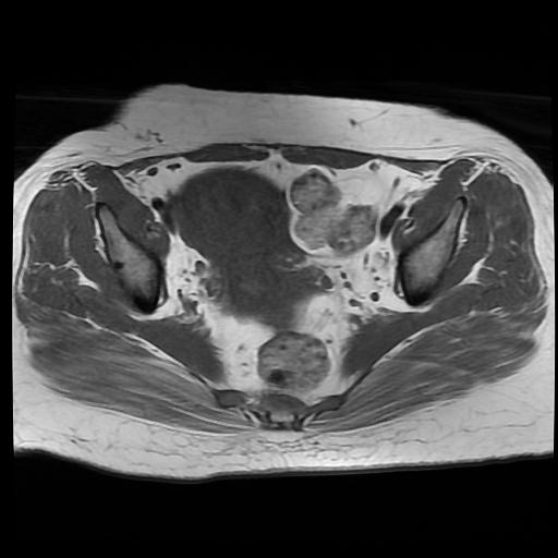 File:Carcinoma of the cervix (Radiopaedia 89018-105858 Axial T1 8).jpg