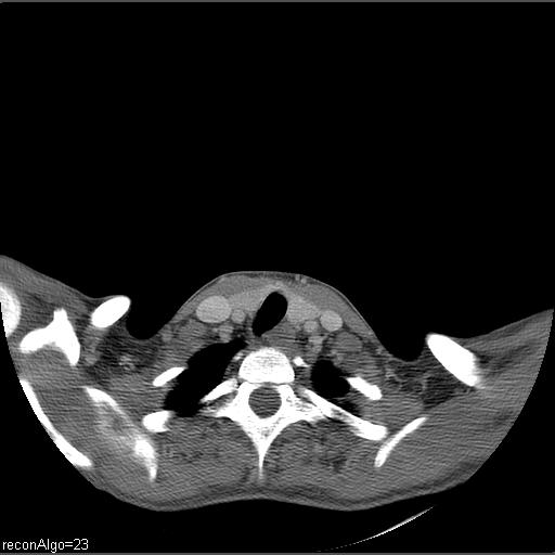 Carcinoma of the maxillary antrum (Radiopaedia 53805-59888 Axial C+ delayed 2).jpg