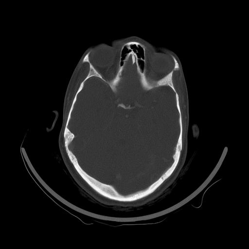 Carcinoma of the maxillary antrum (Radiopaedia 53805-59888 Axial bone window 14).jpg