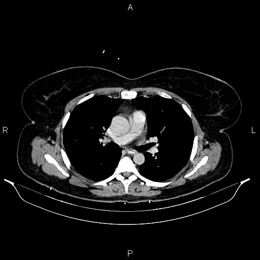 Carcinoma of uterine cervix (Radiopaedia 85861-101700 A 18).jpg