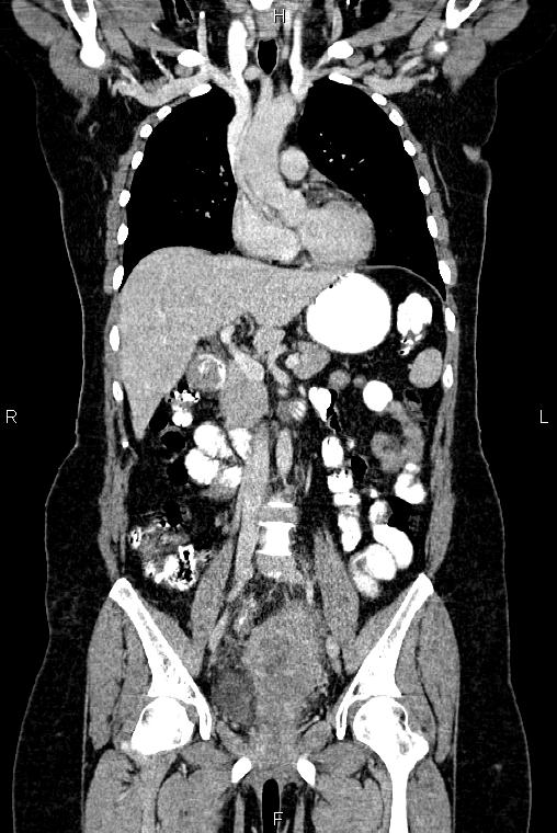 Carcinoma of uterine cervix (Radiopaedia 85861-101700 C 24).jpg