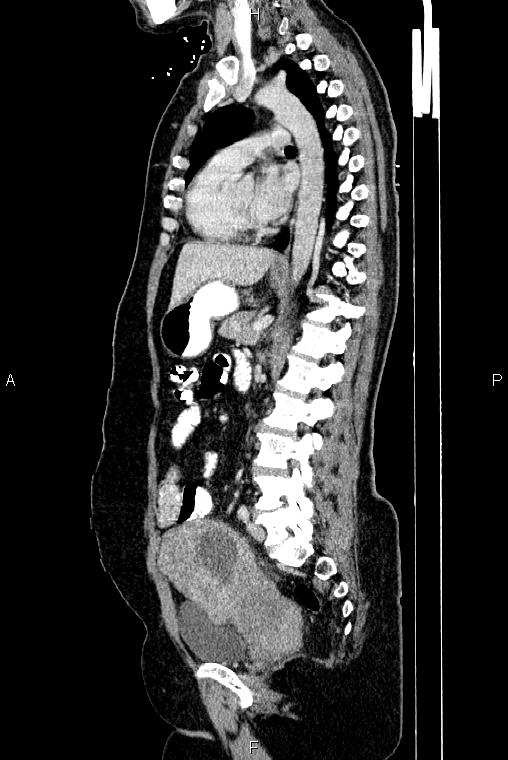 Carcinoma of uterine cervix (Radiopaedia 85861-101700 D 48).jpg