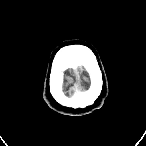 Cardioembolic stroke- ACA and MCA territories (Radiopaedia 58904-66140 Axial non-contrast 162).jpg