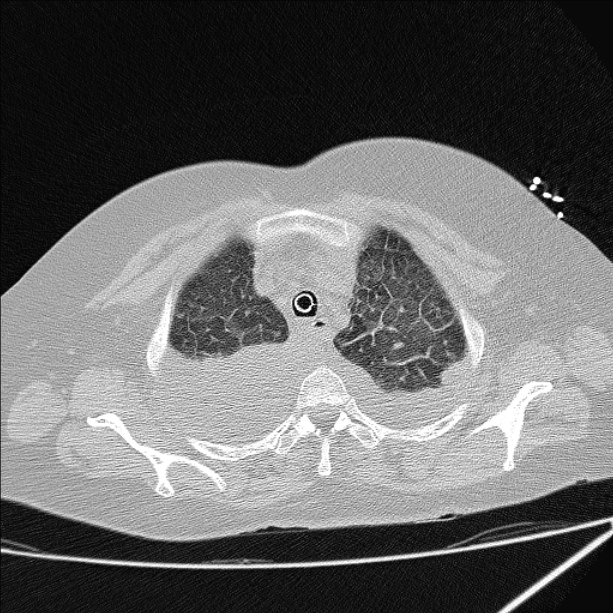 Cardiogenic pulmonary edema (Radiopaedia 29213-29609 Axial lung window 13).jpg