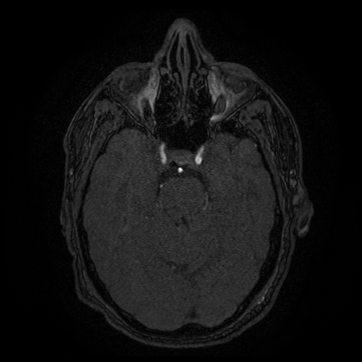 File:Carotid arterial dissection with acute cerebral infarction (Radiopaedia 26636-26784 MRA 112).jpg