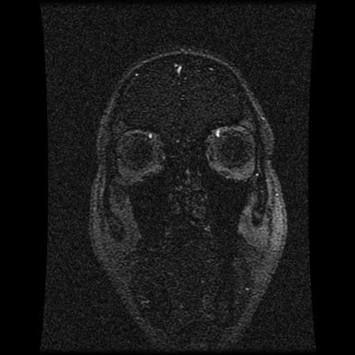 File:Carotid arterial dissection with acute cerebral infarction (Radiopaedia 26636-26784 MRV 136).jpg