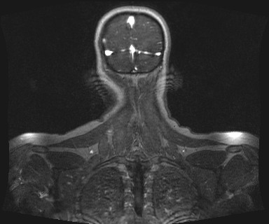 Carotid body tumor (Radiopaedia 12777-12912 MRA 73).jpg
