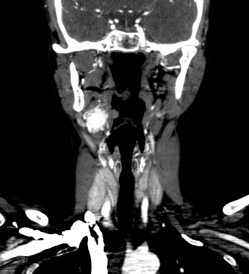 File:Carotid body tumor (Radiopaedia 39845-42300 C 11).jpg