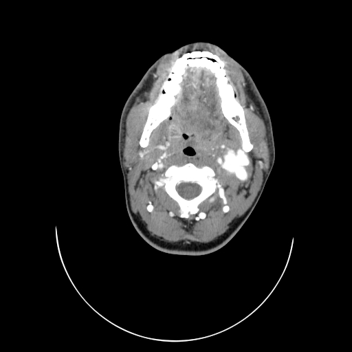 File:Carotid bulb pseudoaneurysm (Radiopaedia 57670-64616 A 20).jpg