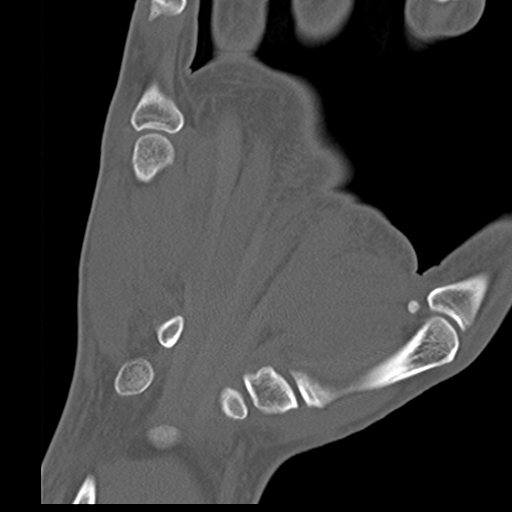 File:Carpo-metacarpal fracture-dislocations with hamatum split fracture (Radiopaedia 18482-18343 Coronal bone window 16).jpg