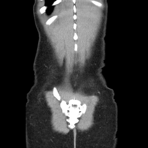 Castleman disease with fibrous pseudotumor in the abdomen (Radiopaedia 77296-89373 B 86).jpg