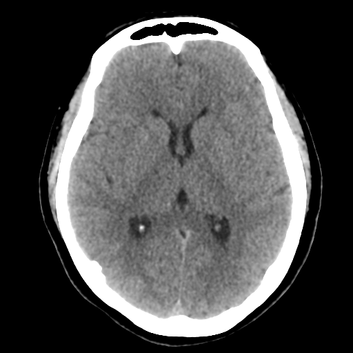 Cavernoma with hemorrhage (Radiopaedia 70755-80931 Axial non-contrast 28).png