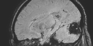 Cavernous hemangioma of the cerebellar falx (Radiopaedia 73025-83724 Sagittal BOLD 70).jpg
