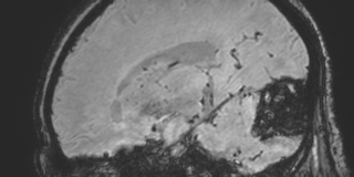 Cavernous hemangioma of the cerebellar falx (Radiopaedia 73025-83724 Sagittal BOLD 78).jpg