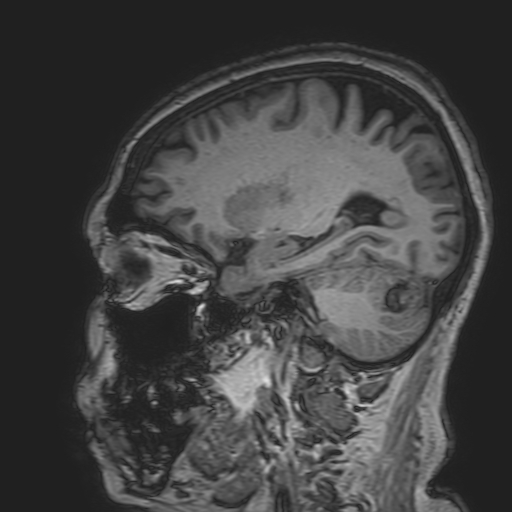 File:Cavernous hemangioma of the cerebellar falx (Radiopaedia 73025-83724 Sagittal T1 71).jpg